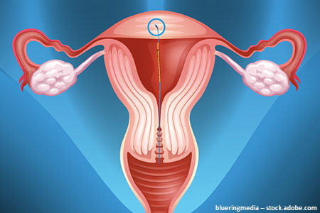 Illustrierte Gebärmutter mit einer GYN-CS Kupfer-Spirale